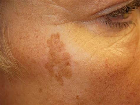 age spots on face vs skin cancer
